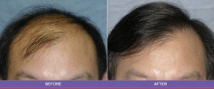 male hair restoration before after