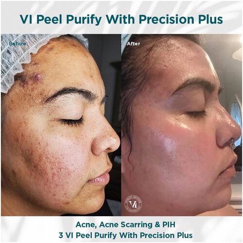 VI Peel With Precision Plus
