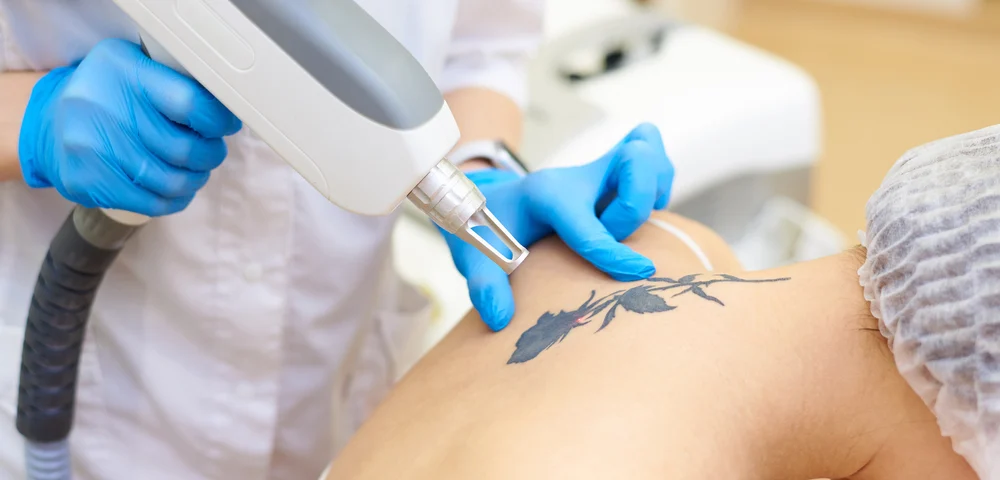 Laser Tattoo Removal Appointments in Harrisburg PA